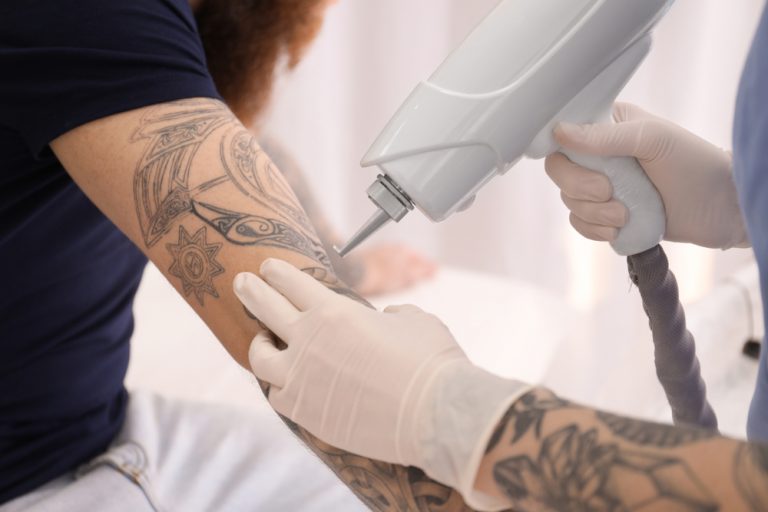 Methods of Tattoo Removal