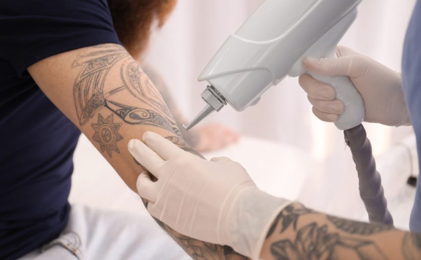 Methods of Tattoo Removal