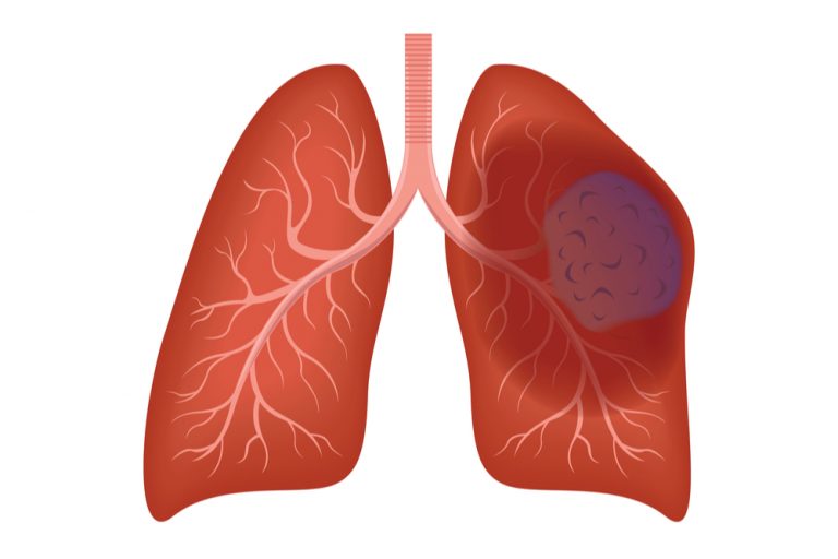14 Surprising Signs Of Lung Cancer