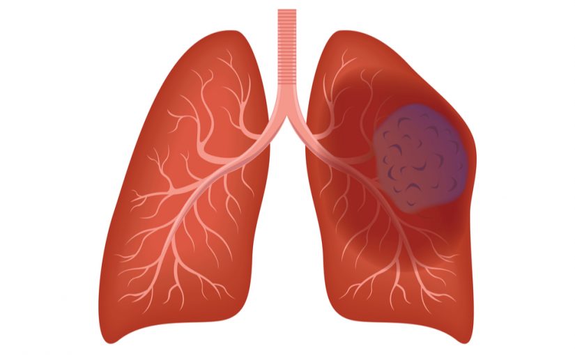 14 Surprising Signs Of Lung Cancer