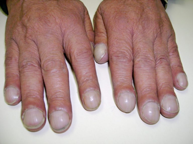 7 Fingernail Problems That Are Actually Serious Health Warnings