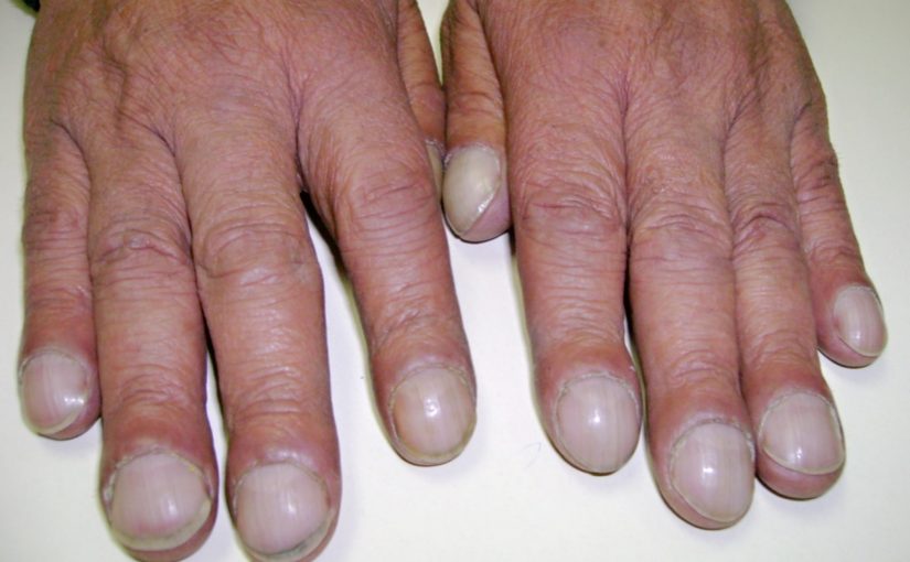 7 Fingernail Problems That Are Actually Serious Health Warnings