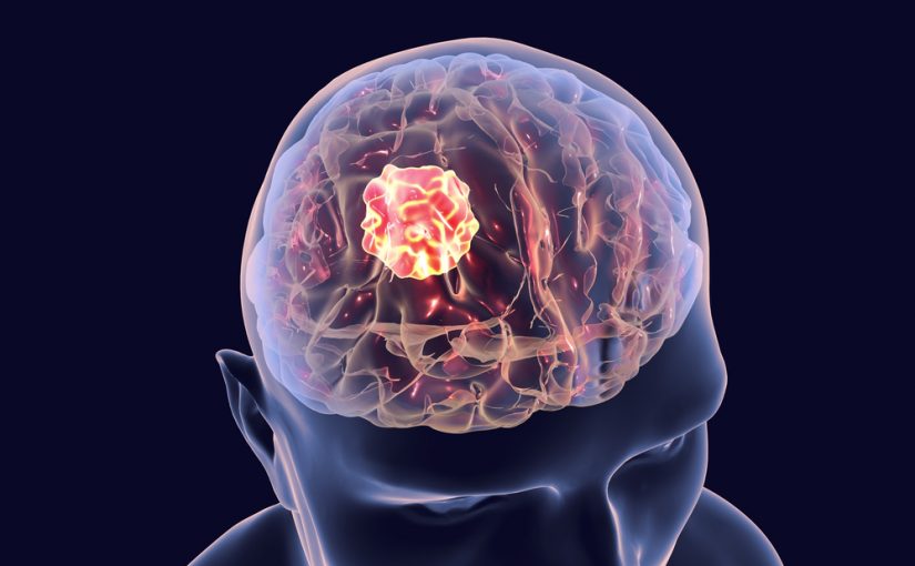 8 Signs You May Have Brain Cancer