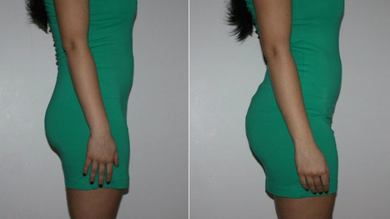 The Scary Truth About Brazilian Butt Lifts