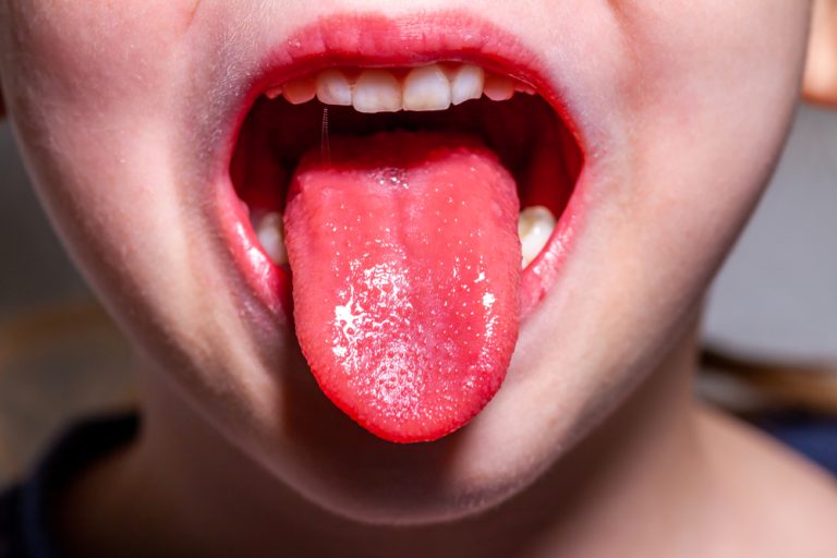 What Is Strawberry Tongue And How To Avoid Catching It