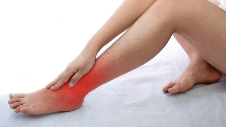 Surprisingly Easy Ways To Get Rid of Varicose Veins