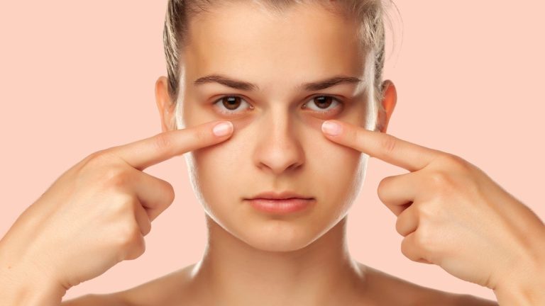 Dark Circles Under the Eye May Be a Major Health Warning